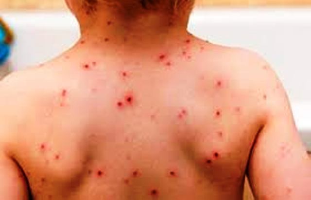 রুপগঞ্জে জলবসন্তের প্রকোপ